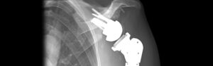 pyrocarbon shoulder replacement