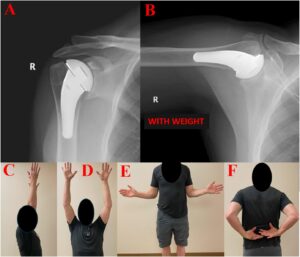 PyroCarbon Shoulder Photo