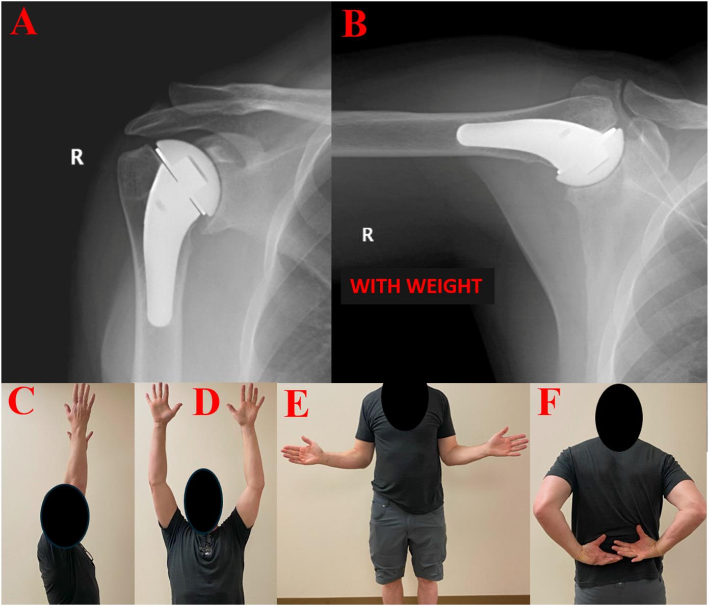 PyroCarbon Shoulder Photo
